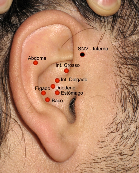  Como sempre acertar na prescrição da Auriculoacupuntura